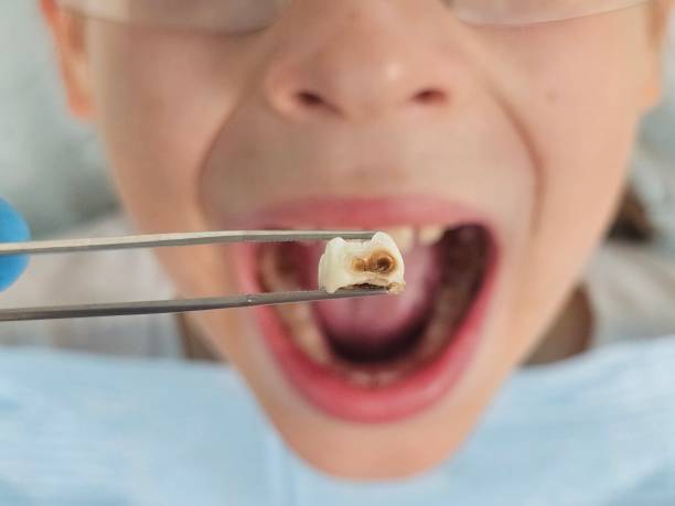 Best Emergency Wisdom Teeth Removal in Mariemont, OH